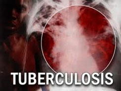 24 марта – Всемирный день борьбы с туберкулезом